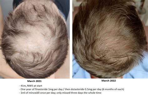 tressless|hairloss forums.